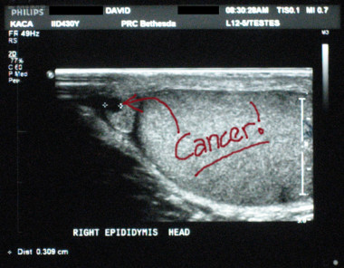 Benign Cyst = Cancer